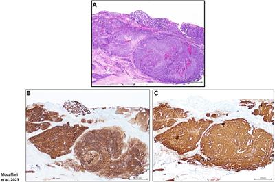 Expression profiles of glucocorticoid-inducible proteins in human papilloma virus-related oropharyngeal squamous cell carcinoma